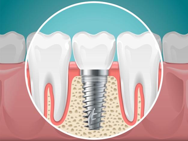 living with dental implants