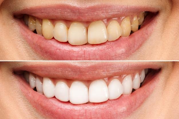 teeth whitening one session