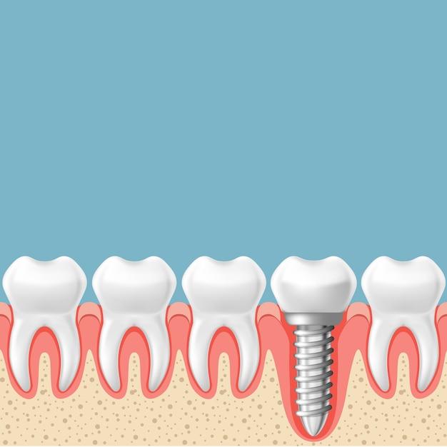 two front teeth on one implant