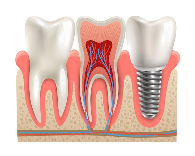 why are dental implants so expensive in the us