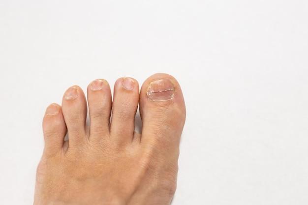 Can Drawing Salve Help An Ingrown Toenail 